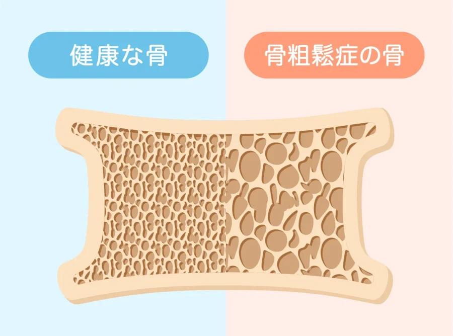 骨粗しょう症