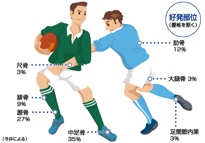 疲労骨折の好発部位