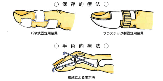 マレットフィンガーの治療