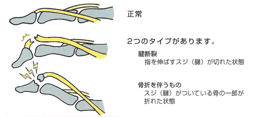 マレットフィンガーの症状