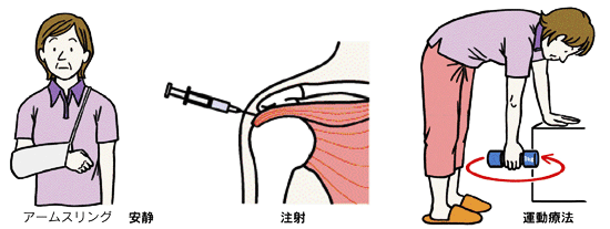 肩関節周囲炎の治療