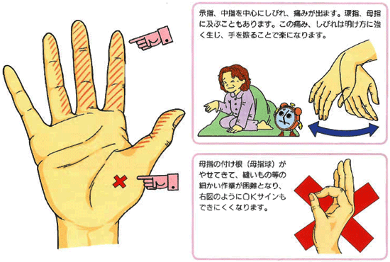 手根管症候群の症状