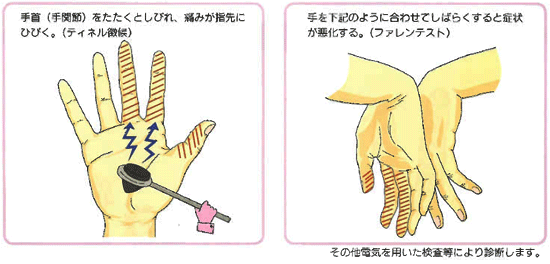 手根管症候群の診断
