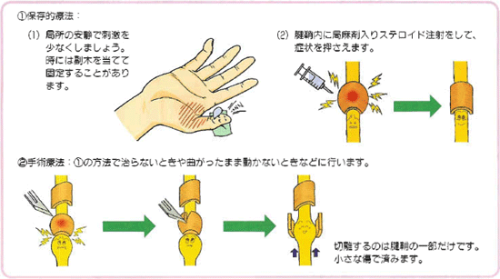 ばね指の治療