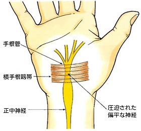 手根管症候群とは