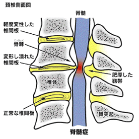 頚椎症性脊髄症の原因