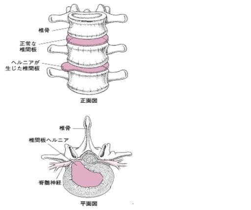 腰椎椎間板ヘルニアとは