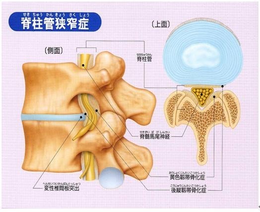 腰部脊柱管狭窄症とは