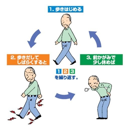 腰部脊柱管狭窄症の症状