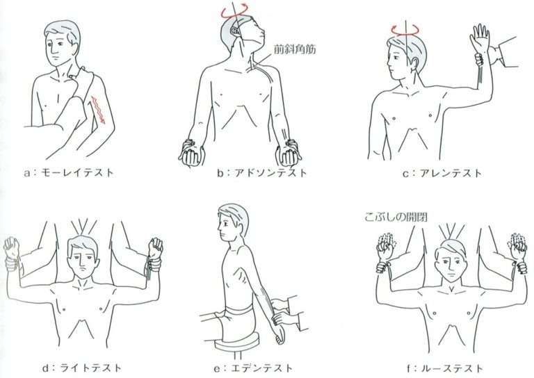 胸郭出口症候群の診断