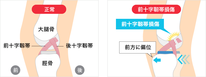 前十字靭帯損傷の症状